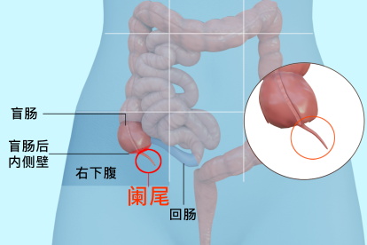 阑尾的位置有哪些 | 百度健康·医学科普