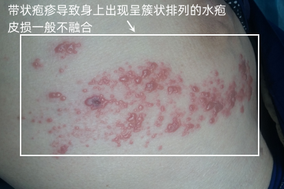 带状疱疹的症状图片
