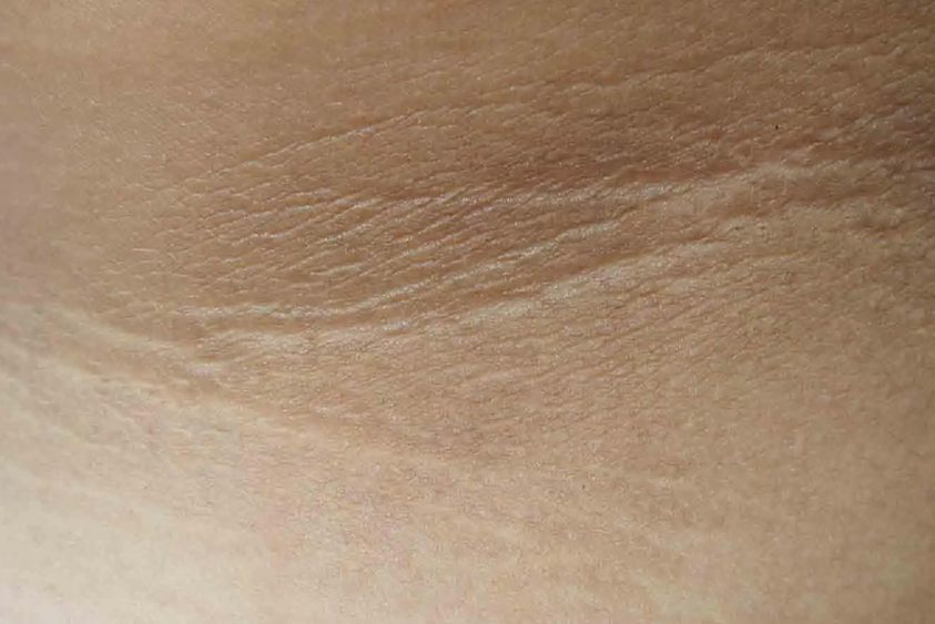 大腿根黑棘皮症图片