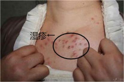 皮肤片状红疹图片 | 百度健康·医学科普