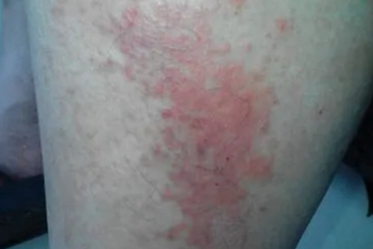 月经疹大腿丘疹图片