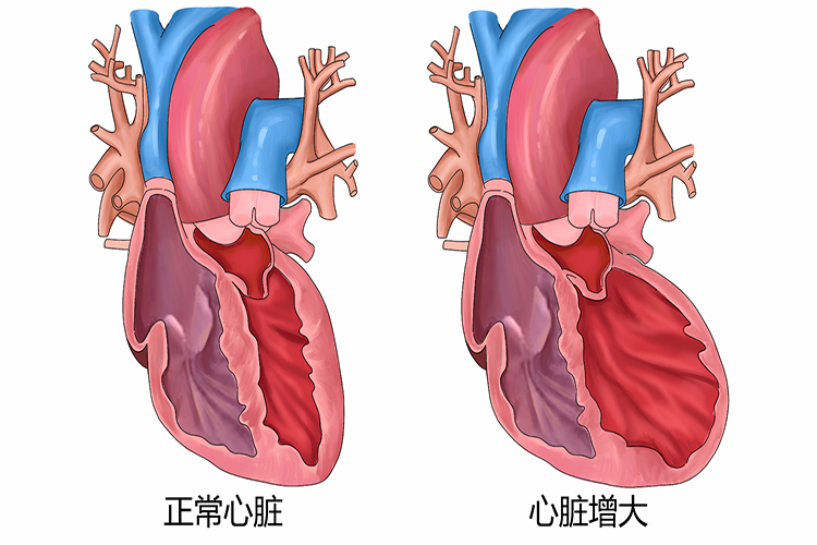 正常心脏vs.心脏增大