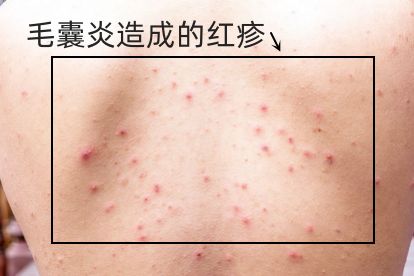 红疹原因及图片大全