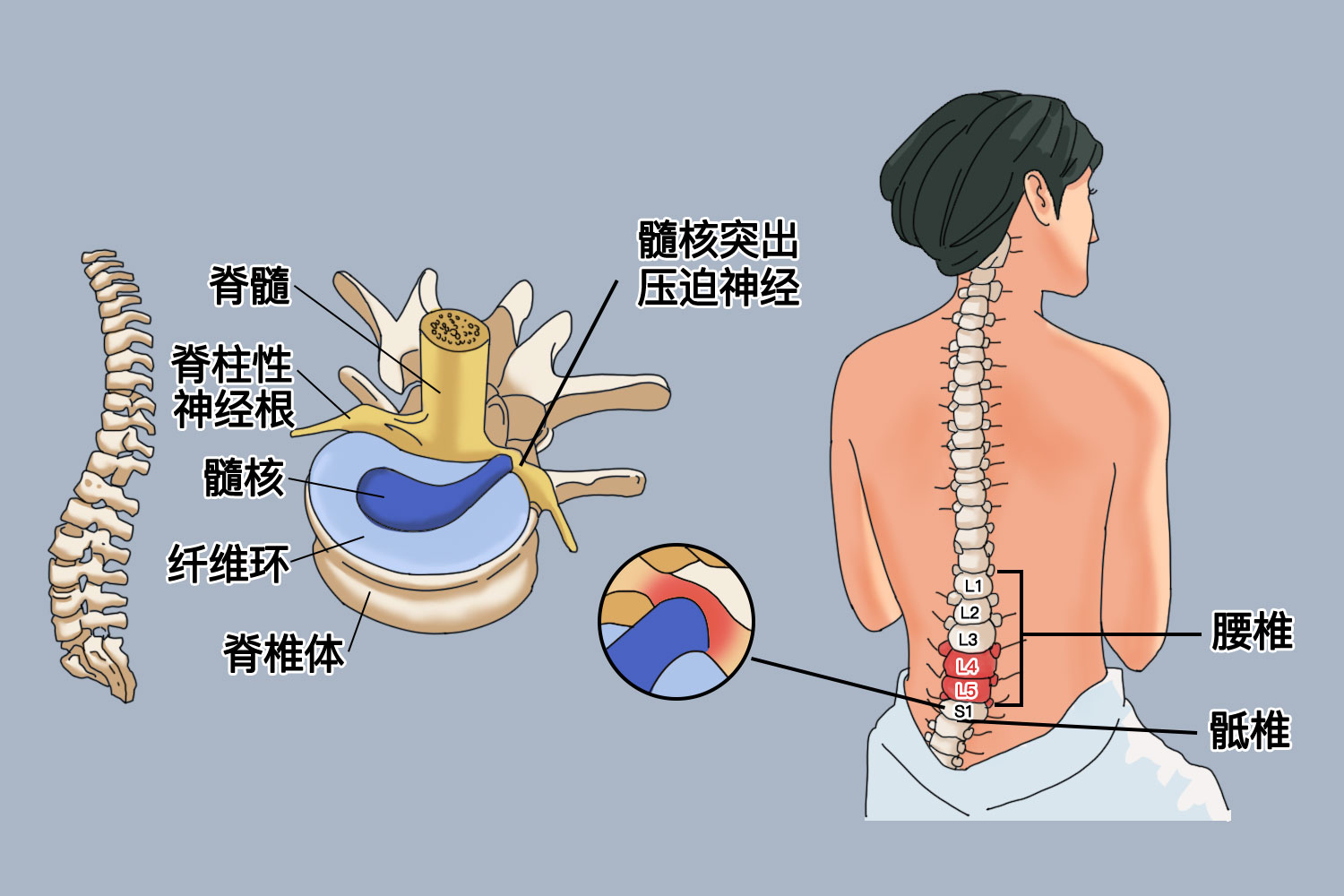 腰椎间盘突出的位置示意图 | 百度健康·医学科普