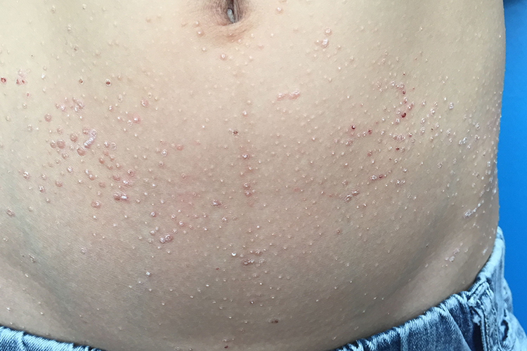 艾滋初期丘疹图片 | 百度健康·医学科普