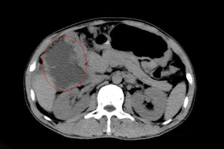 肠梗阻CT扩张肠曲图