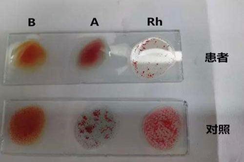 a溶血环和b溶血环的区别图表a溶血环和b溶血环的区别图表