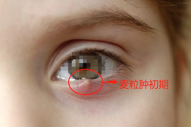 麦粒肿症状早期症状图片 | 百度健康·医学科普