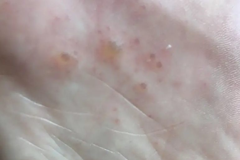 汗疱疹和脚气区分图片