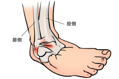 腓侧和胫侧怎么区分图片