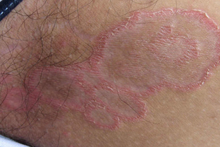 股癣左侧大腿根有环状红斑图 