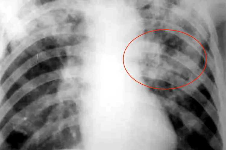 浸润型肺结核X线图