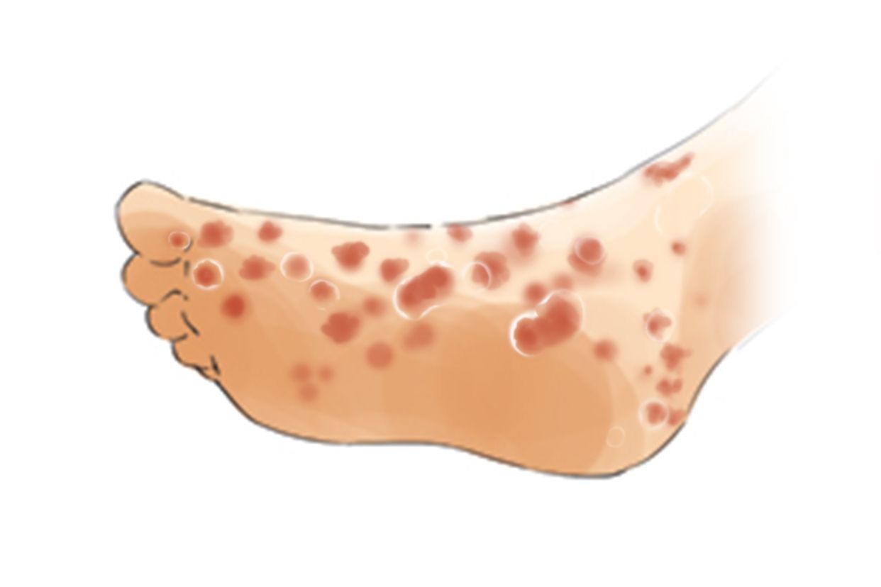 梅毒二期的症状和图片 | 百度健康·医学科普
