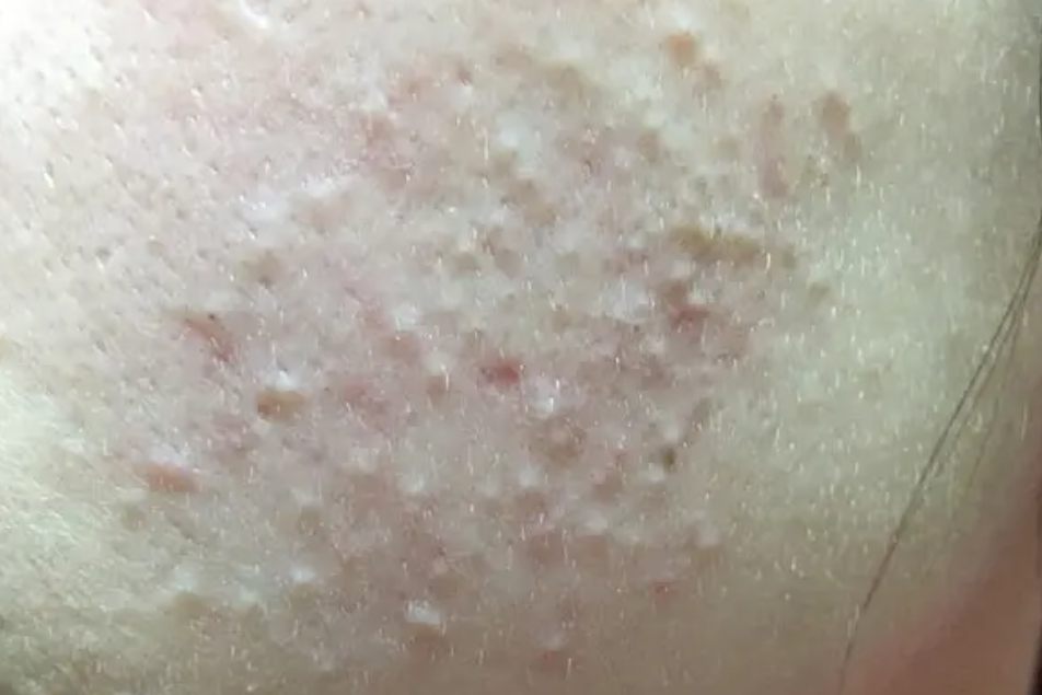 闭口粉刺痘痘图片 | 百度健康·医学科普