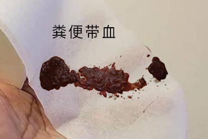 哪种粪便需要做肠胃镜图片