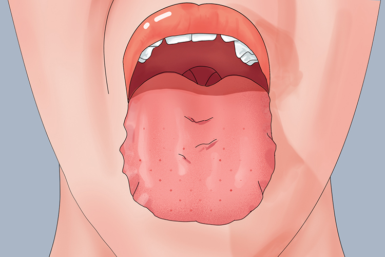 舌边齿痕印图