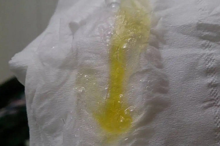 绿脓杆菌痰液图片 | 百度健康·医学科普