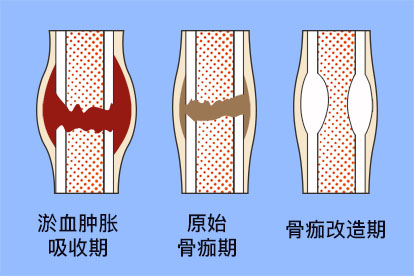 骨痂生长过程图