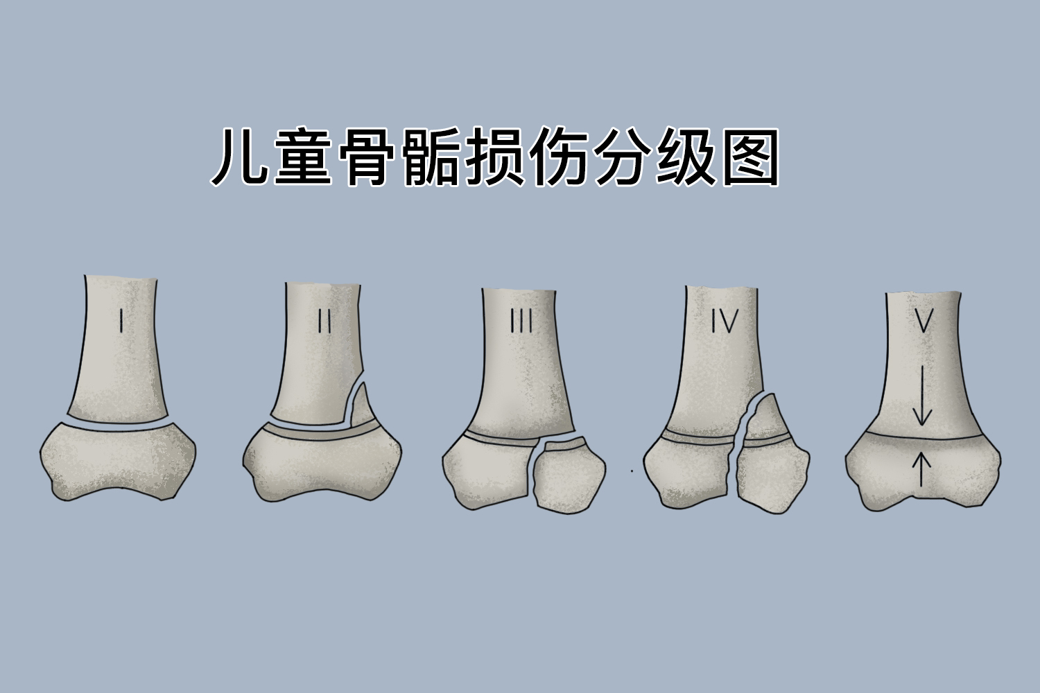 儿童骨骺损伤分型图片