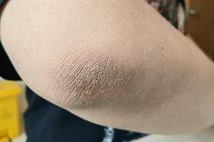 黑棘皮病肘部症状图片