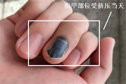指甲内挤压伤需要几天恢复正常图片