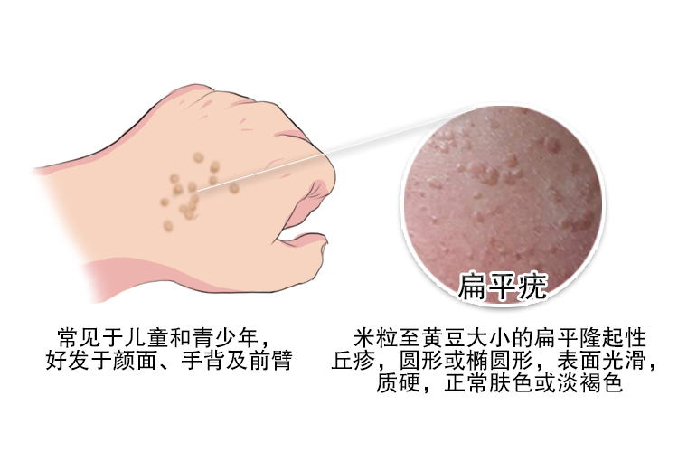 疣有哪几种图片