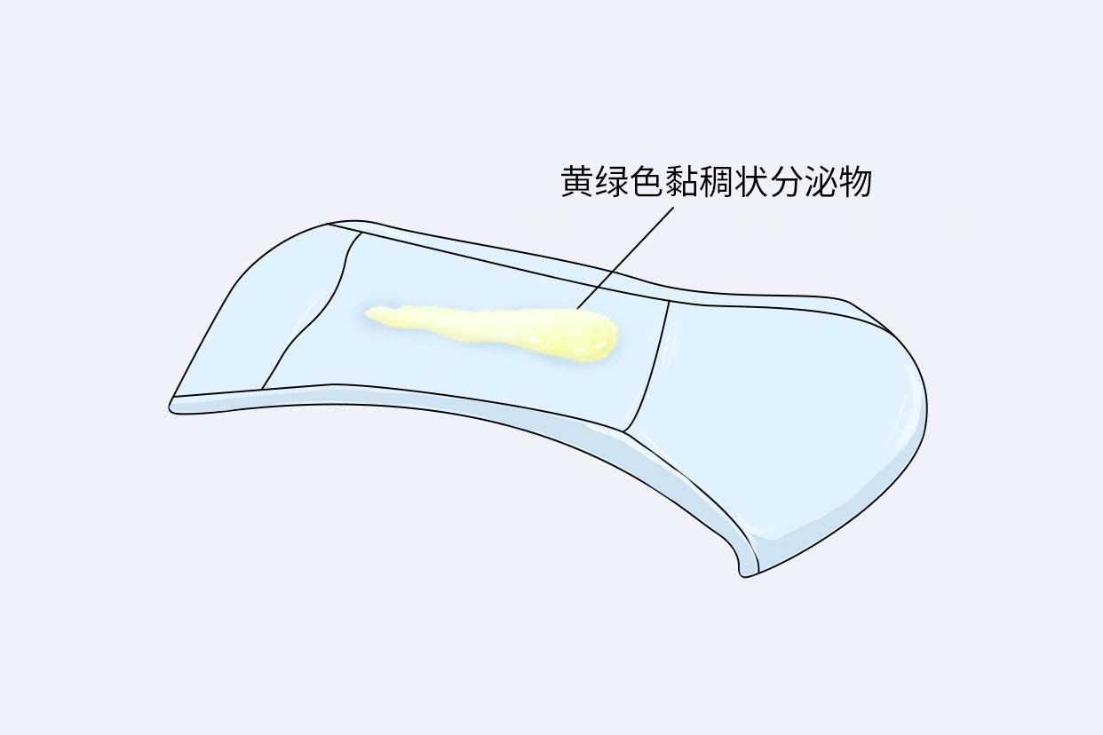 脓样分泌物图片 | 百度健康·医学科普