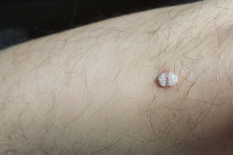 肛门皮赘和疣的区别图片