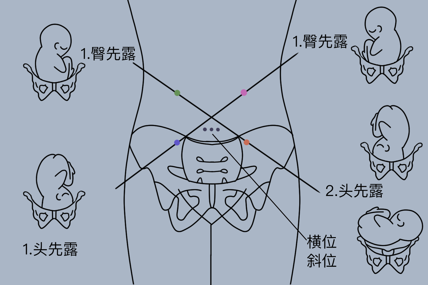 胎心位置与胎位图解