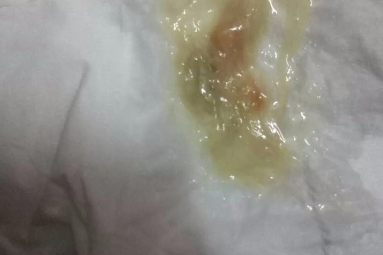 绿脓杆菌痰液图片 | 百度健康·医学科普
