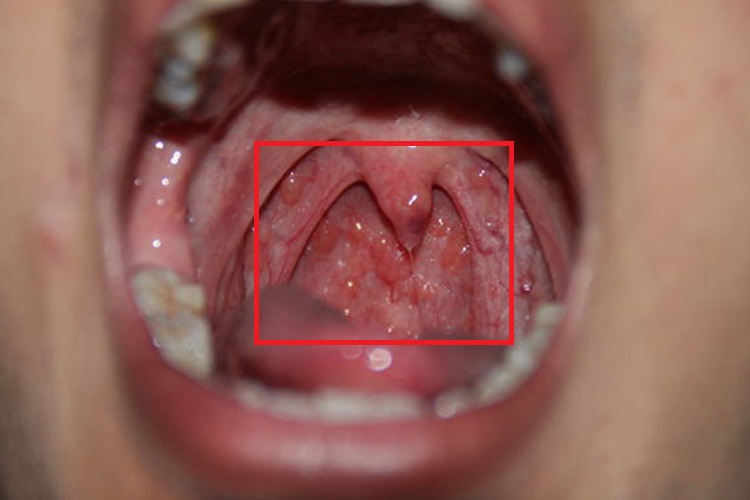 咽白喉悬雍垂增生图