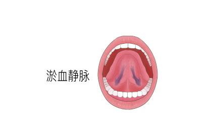 舌下青筋淤血图片 | 百度健康·医学科普