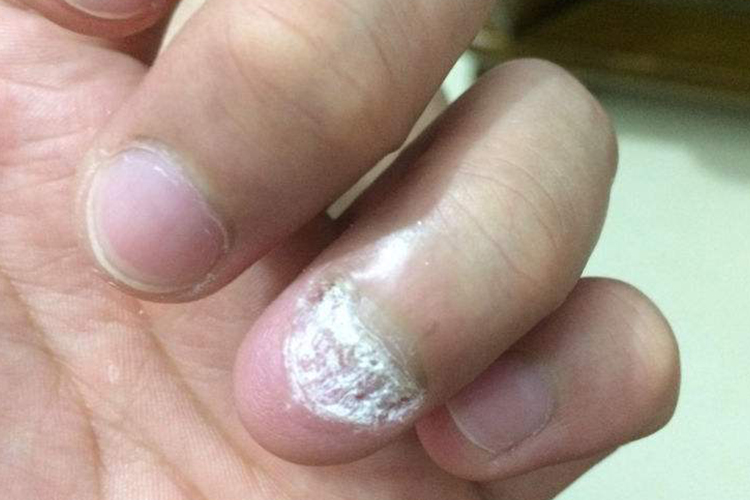 甲藓指甲分层图