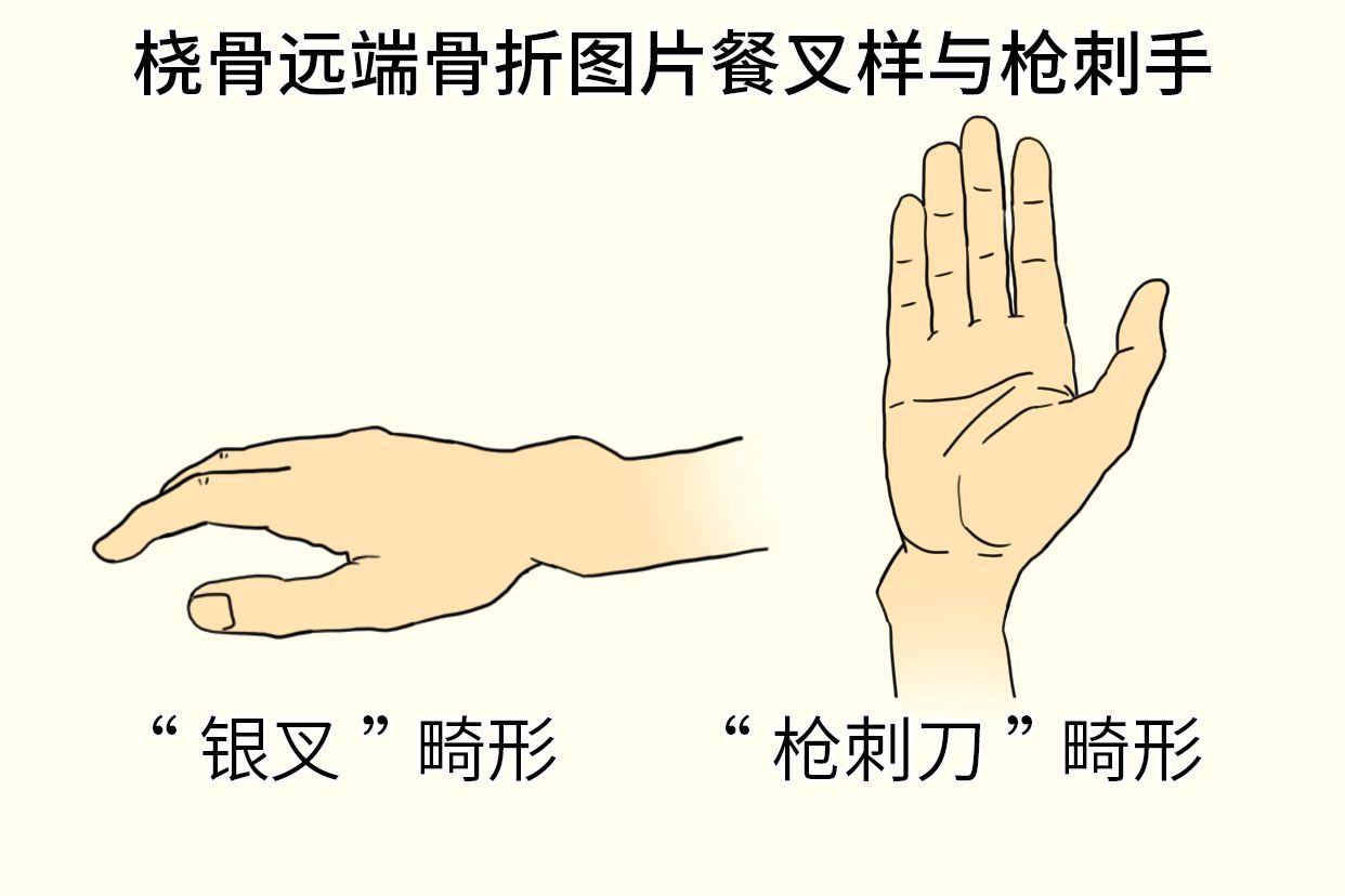 桡骨远端骨折餐叉样与枪刺手图