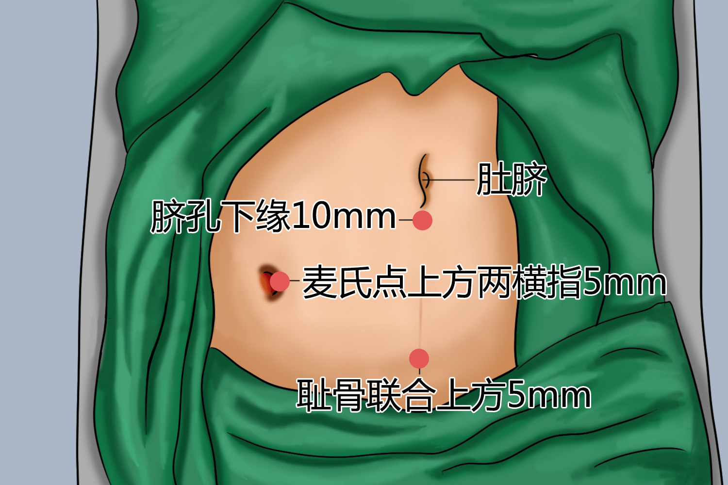 阑尾炎手术切口位置示意图
