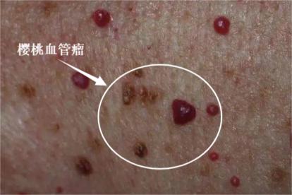 樱桃血管瘤图片和症状