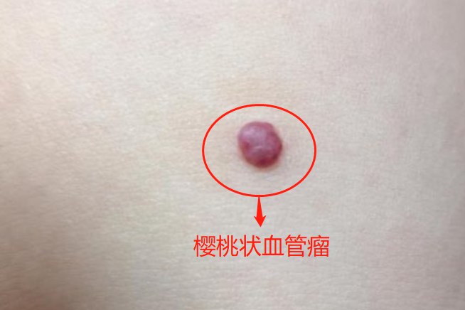 胸前有红色的小血痣图片
