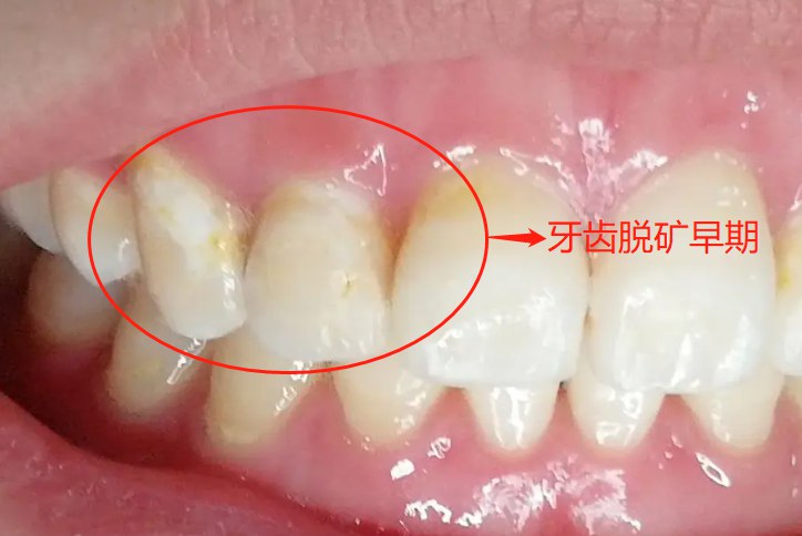 牙齿脱矿早期及补救图片