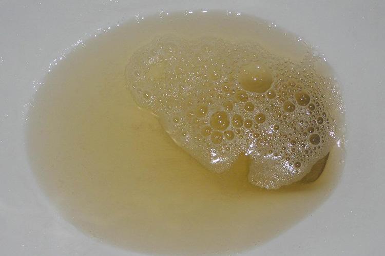 正常尿液有泡沫吗图片