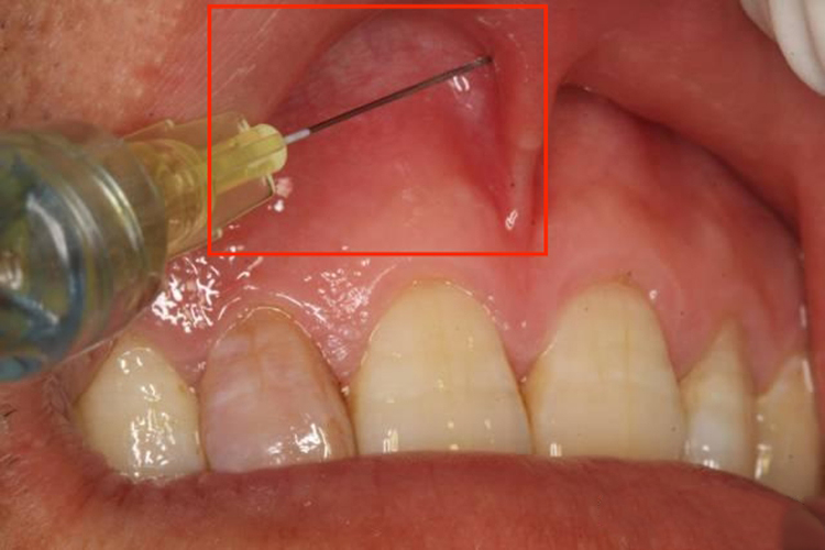 口腔前庭沟位置图