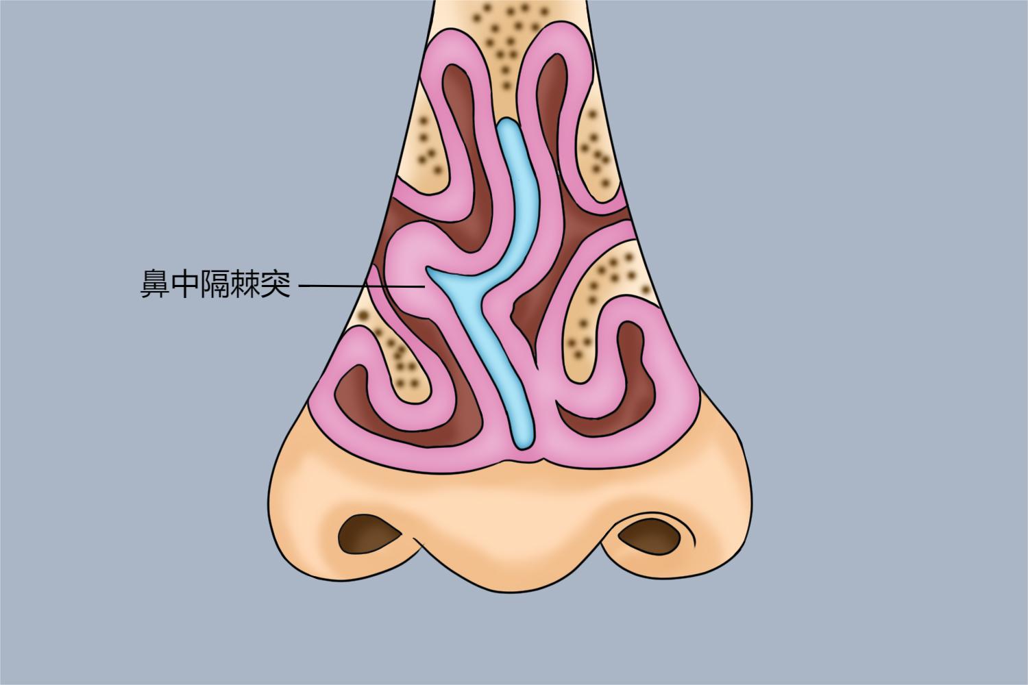 鼻中隔棘突图片