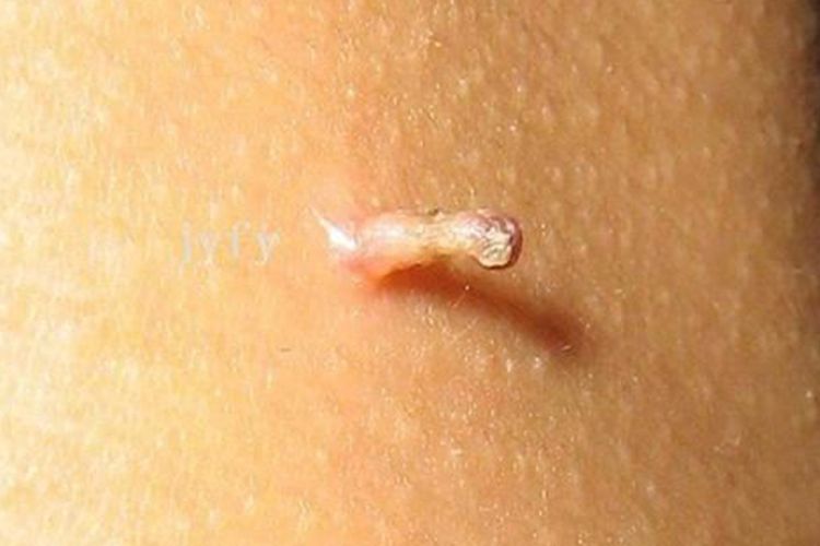 大腿内侧长了个肉芽状疣体图片