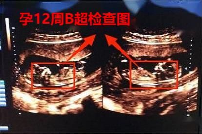孕12周B超图
