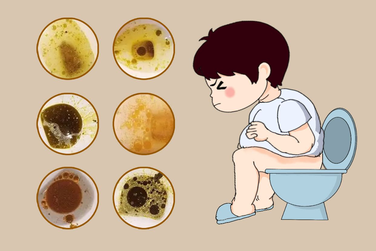 减肥排出油便图片 | 百度健康·医学科普