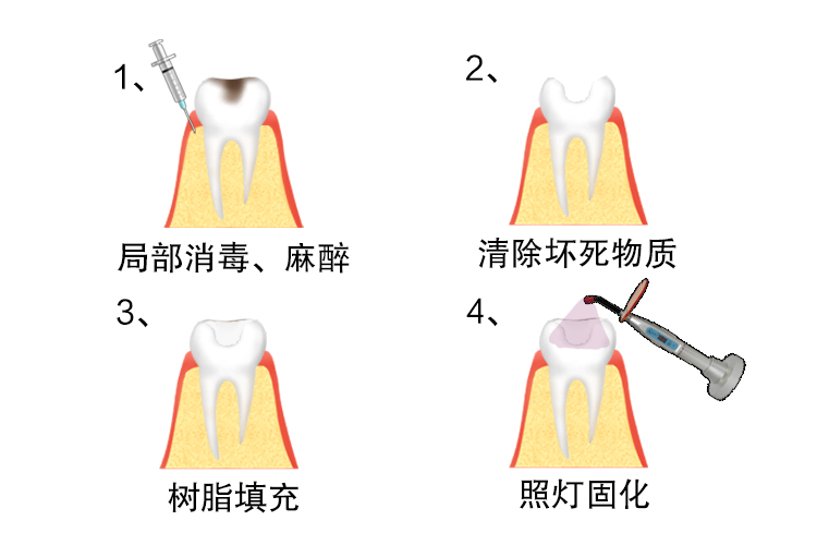 树脂补牙图片 | 百度健康·医学科普