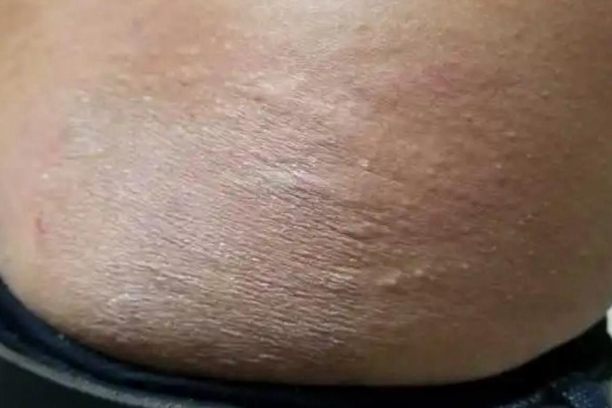 因潮湿起的疙瘩