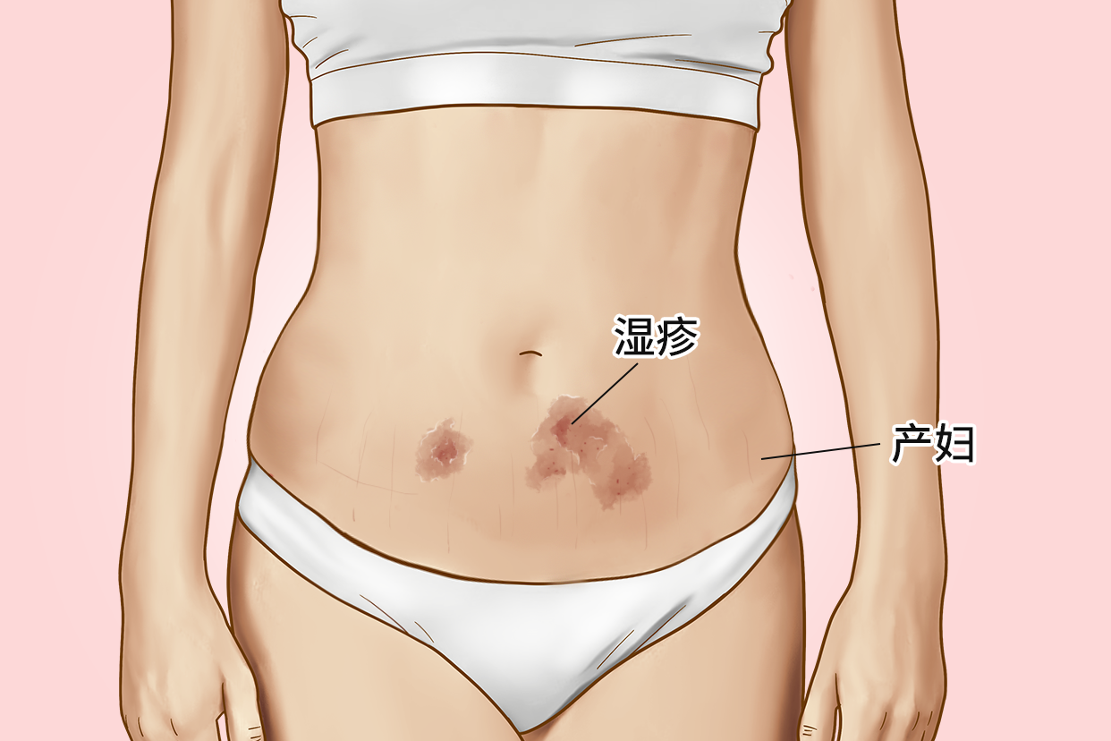 产后肚子上长湿疹图片