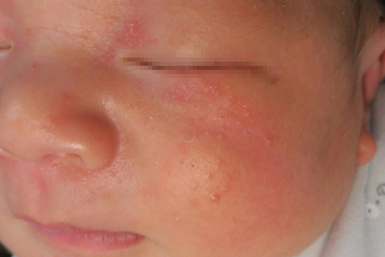 婴儿面部湿疹丘疱疹图