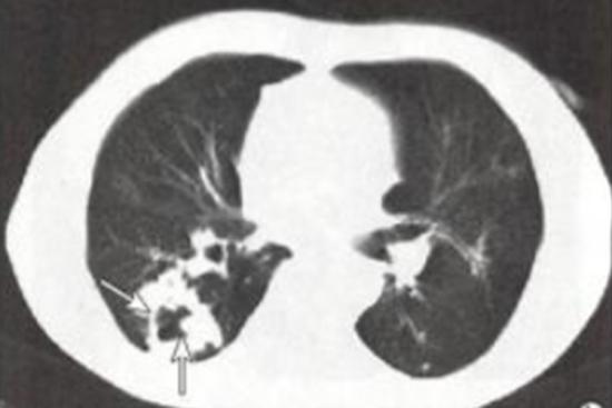 肺空洞与空腔CT图