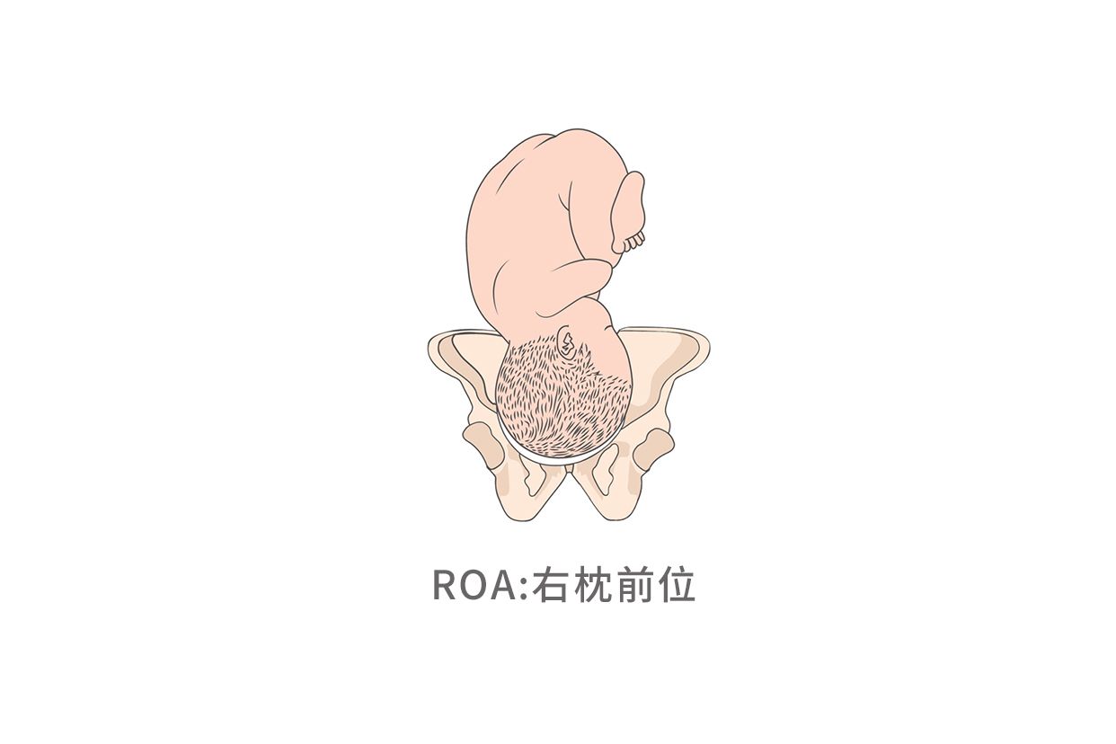 胎位roa图片 | 百度健康·医学科普